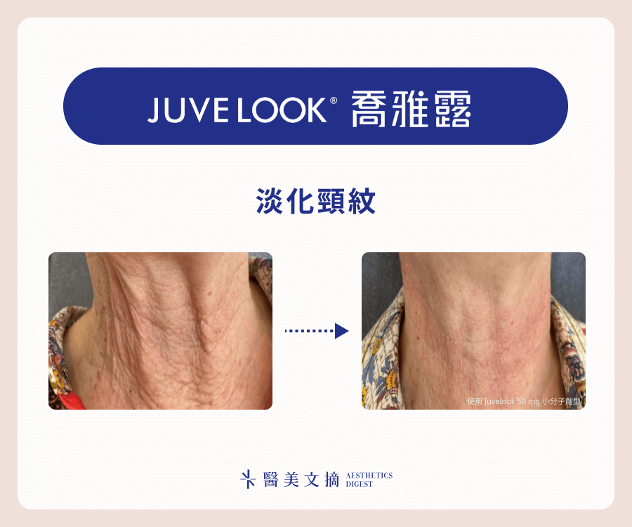juvelook喬雅露淡化頸紋效果