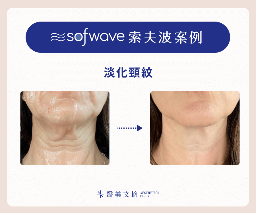 sofwave索夫波淡化頸紋效果