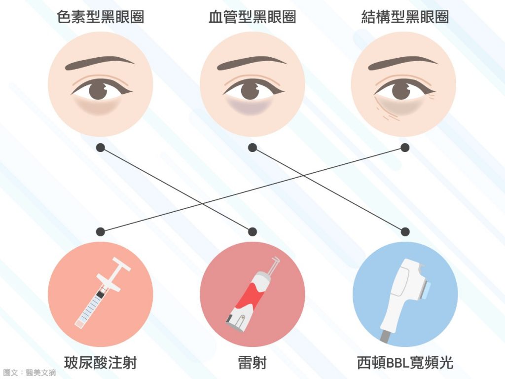 不同類型黑眼圈的治療方法