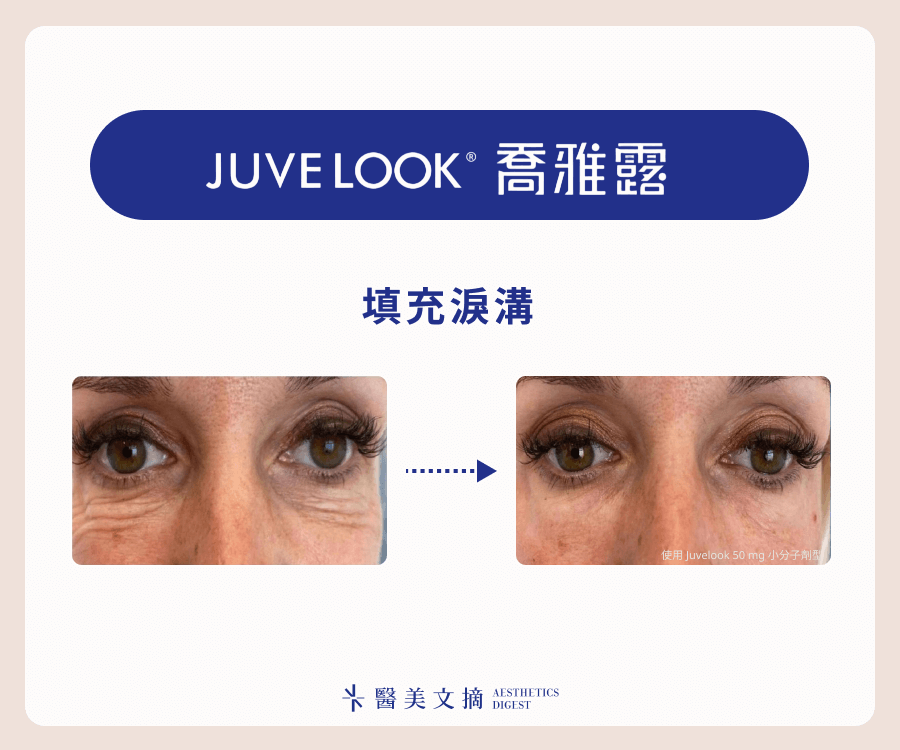  Juvelook喬雅露填充淚溝