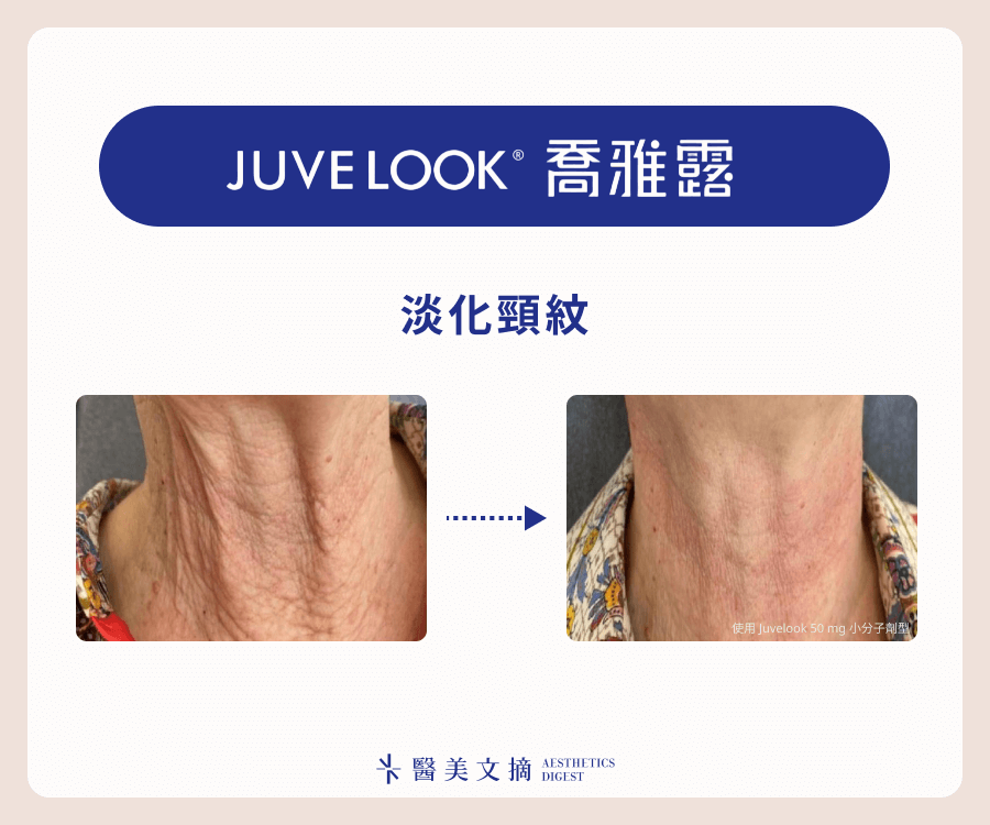  Juvelook喬雅露淡化頸紋