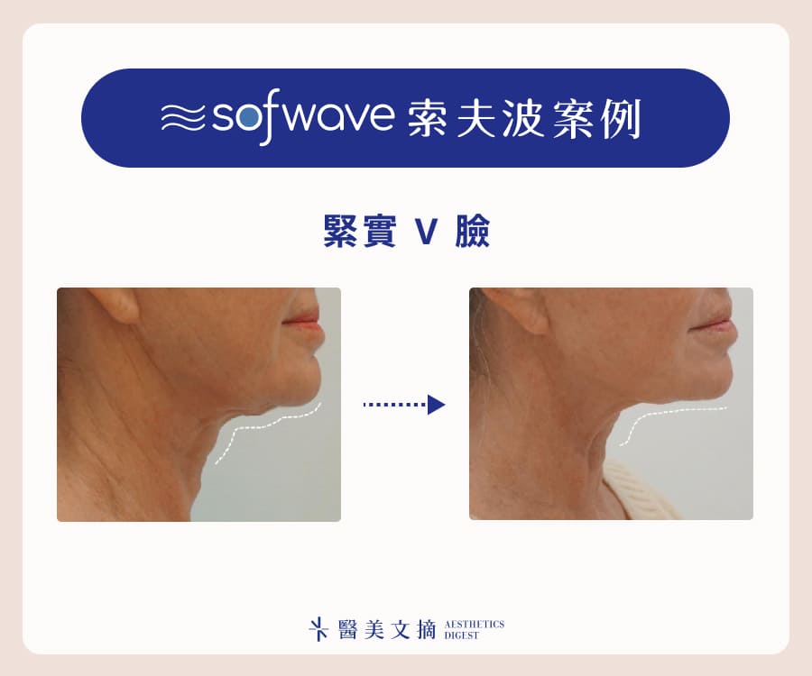 索夫波案例緊實V臉