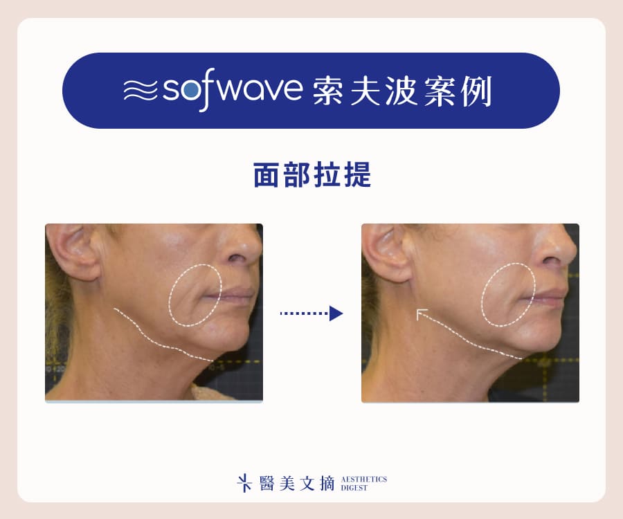 索夫波案例面部拉提