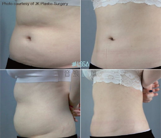 LSSA音浪脂雕 腹部對比照