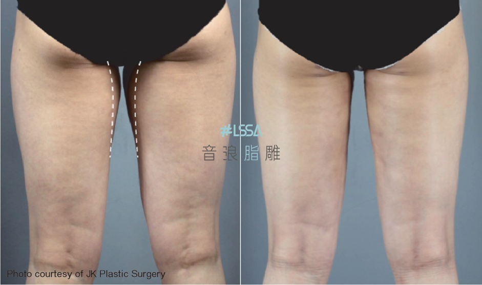 LSSA音浪脂雕 腿部對比照