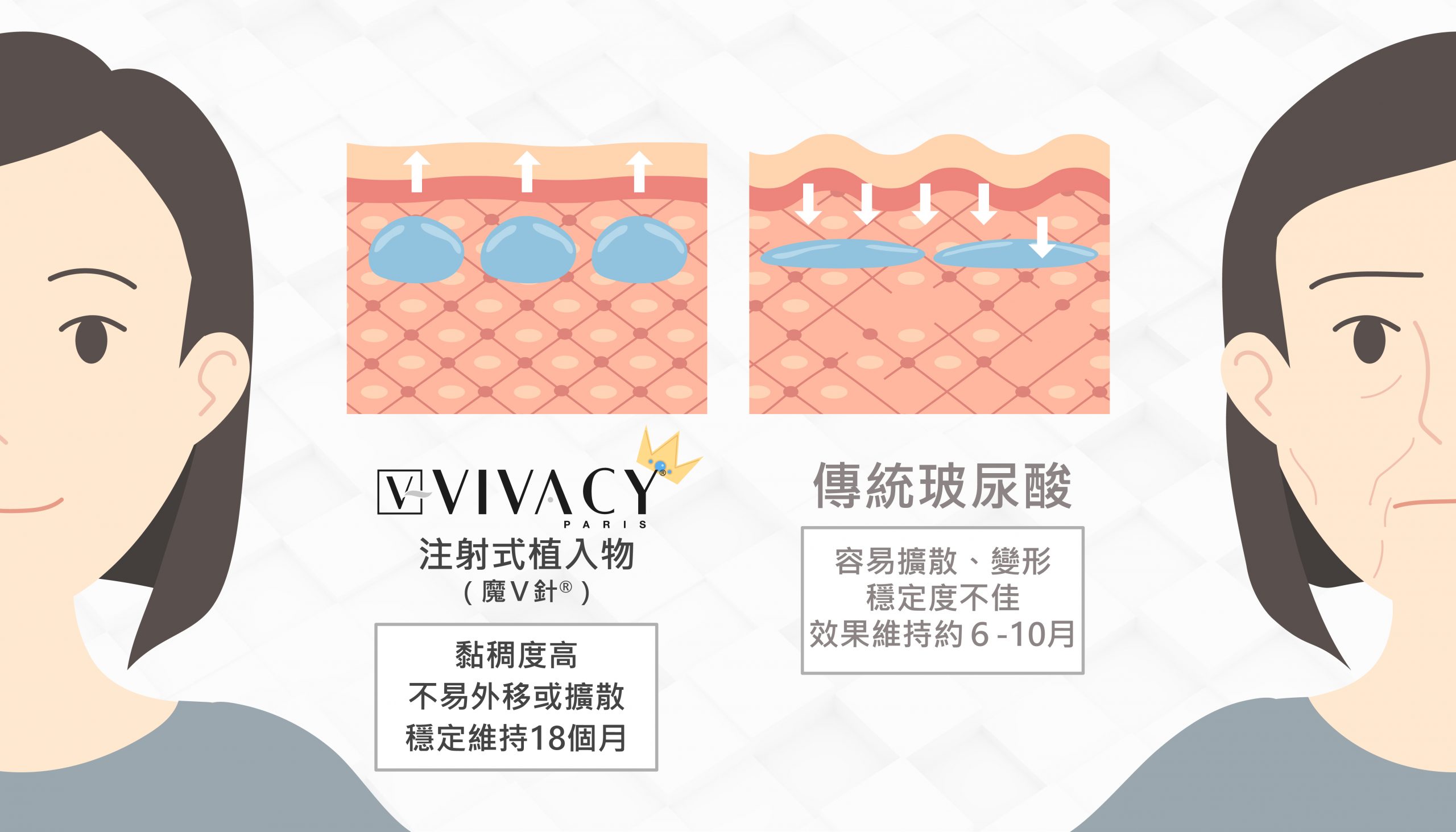 Vivacy魔V針可以維持18個月