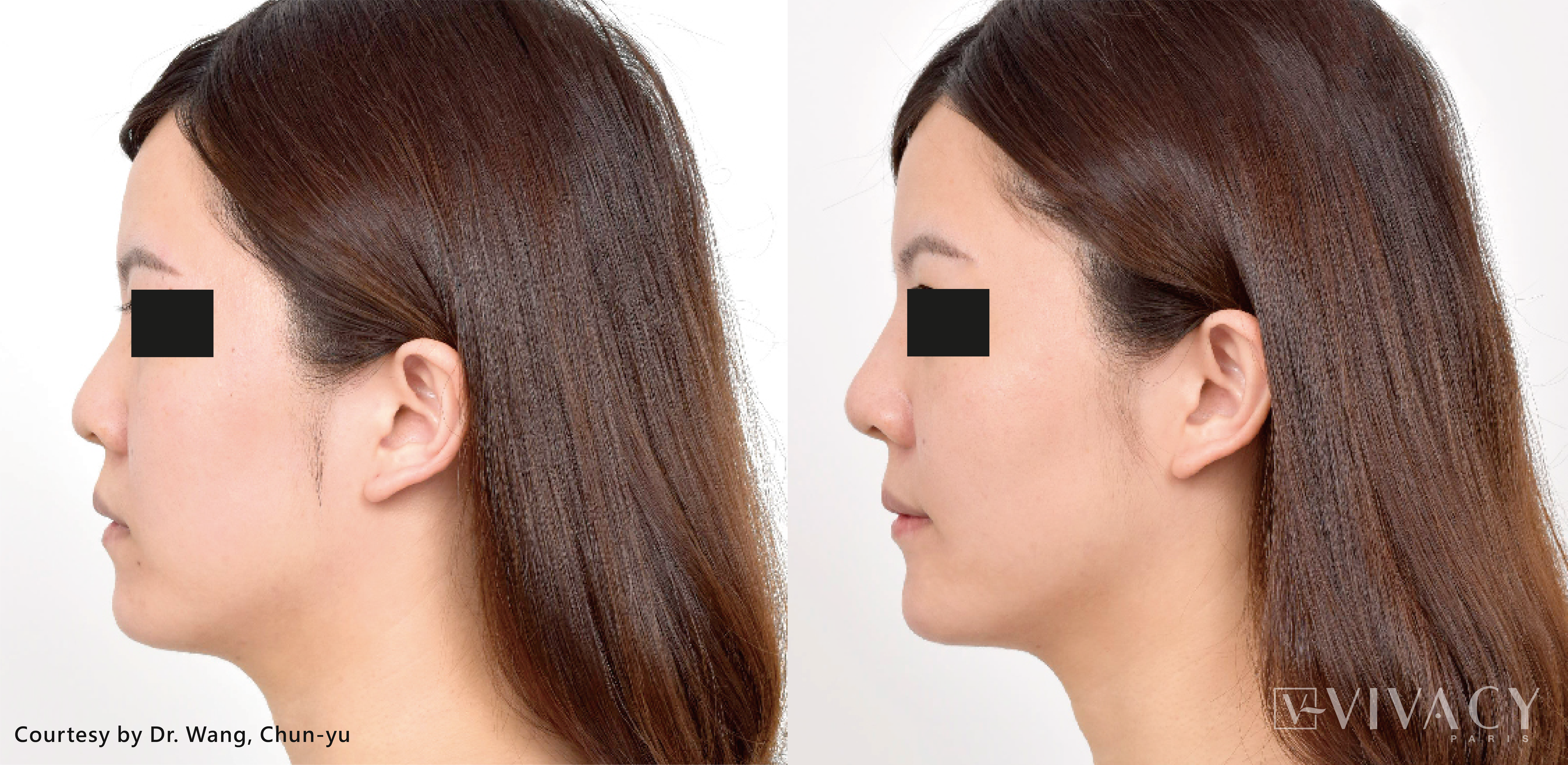 Vivacy注射式植入物效果