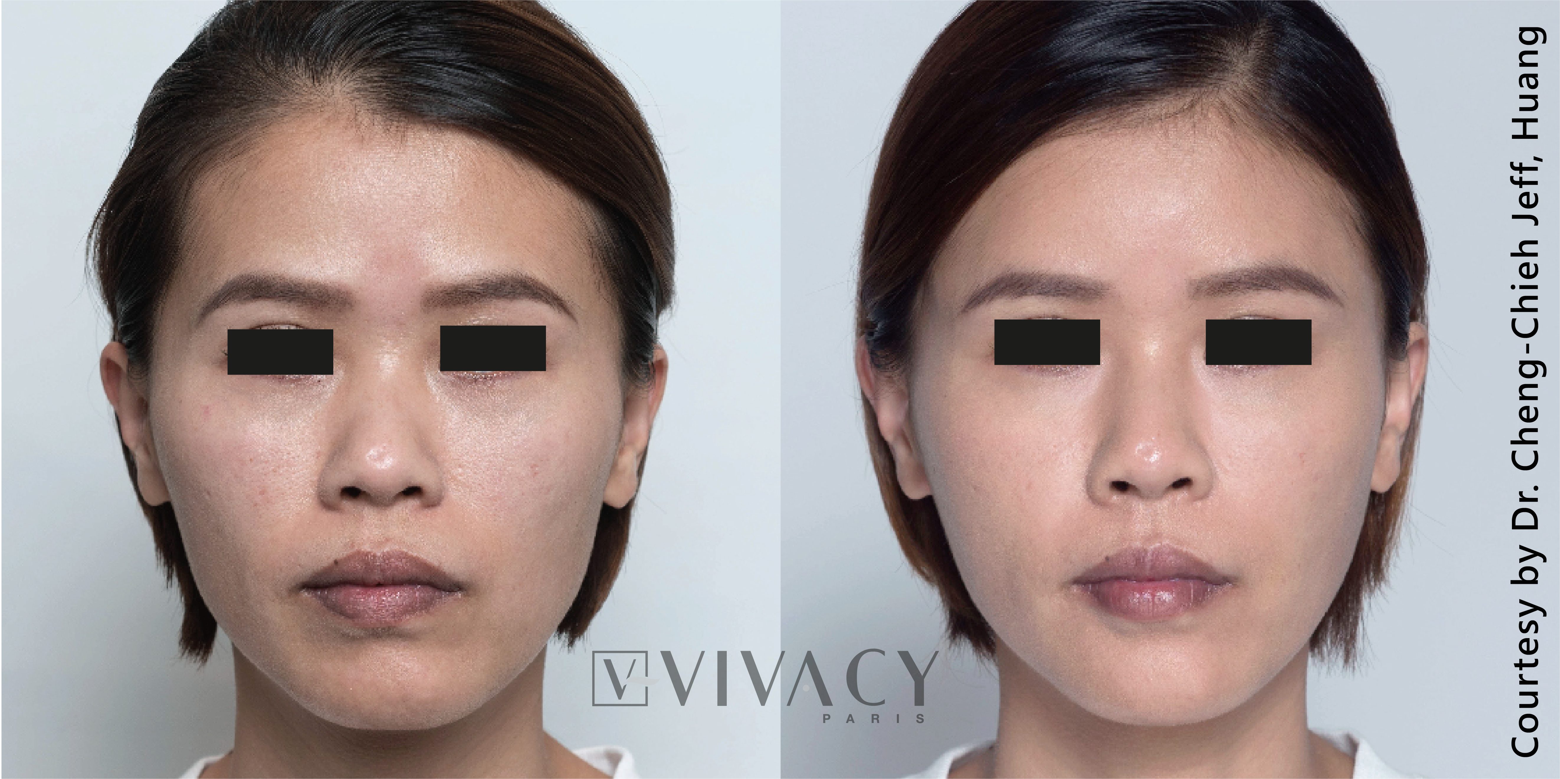 Vivacy注射式植入物效果