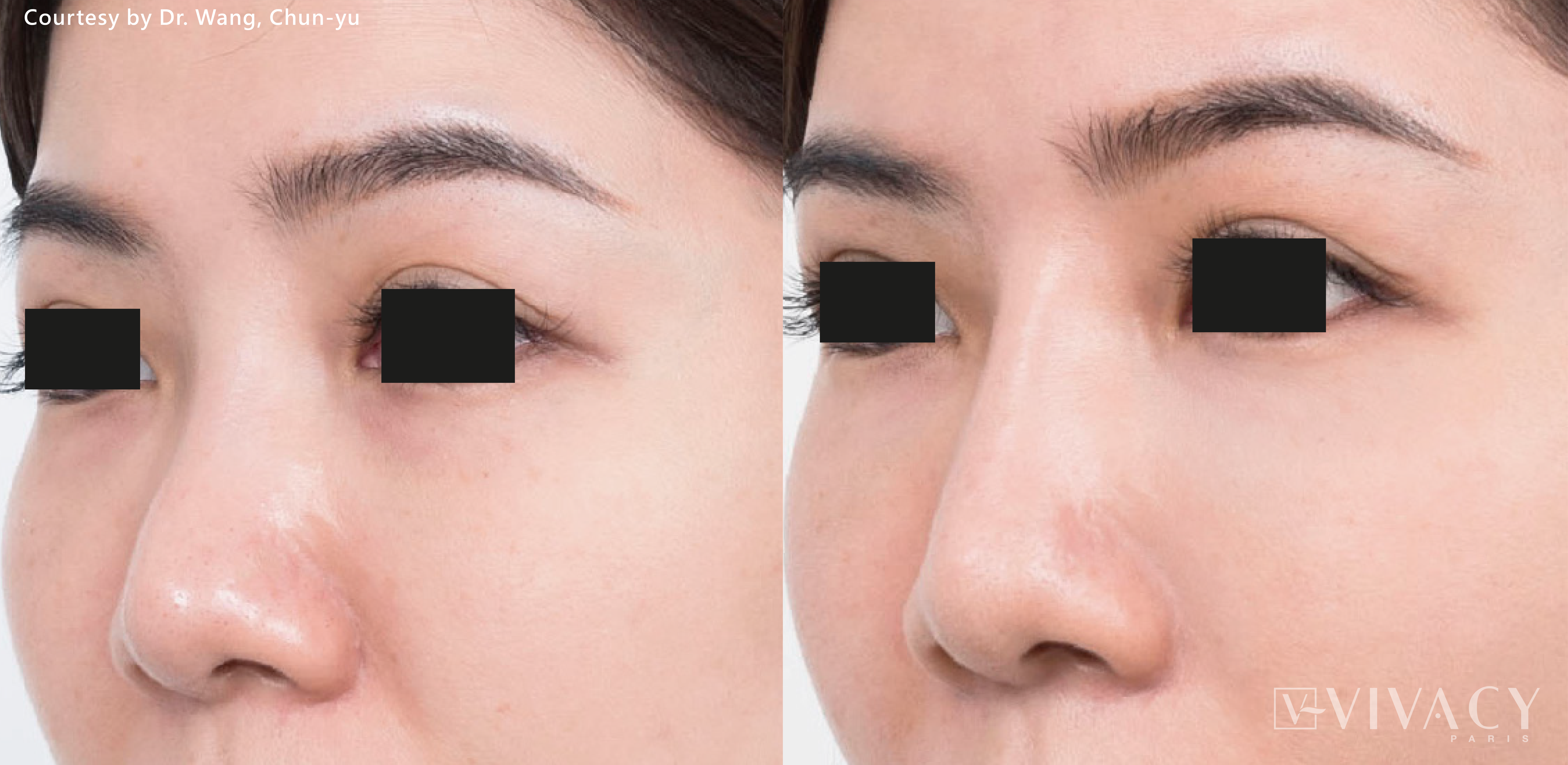 Vivacy隆鼻效果