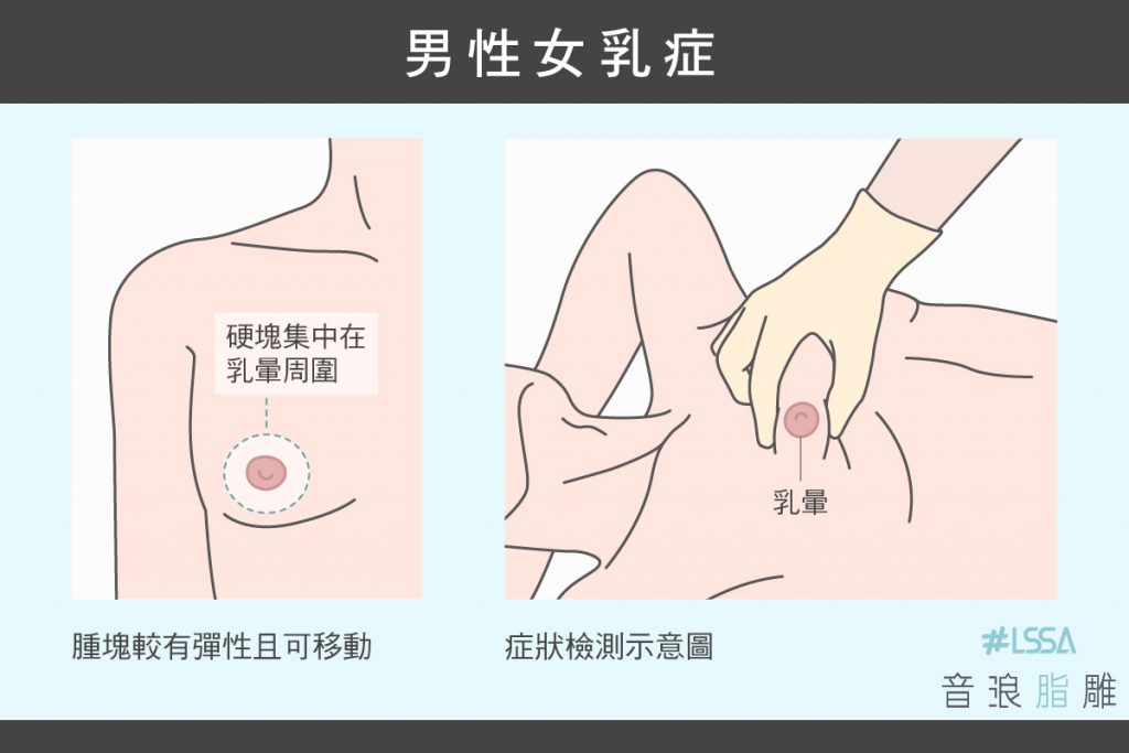 男性女乳症