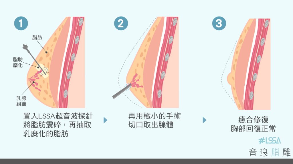 LSSA音浪脂雕 抽脂 女乳症