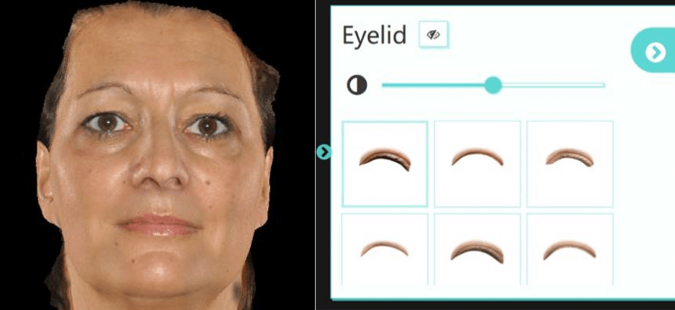 Quantificare 3D影像系統-雙眼皮術前模擬術後成果