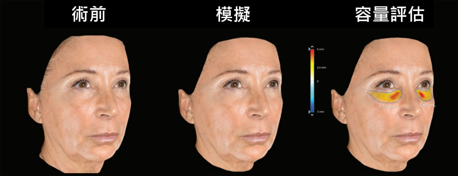 施打公主玻尿酸或其他微整形治療，能夠精準預測需要多少劑量