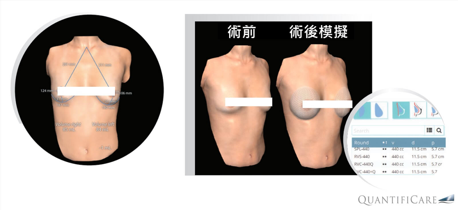 隆乳手術前測量，預估植入物尺寸並術後模擬