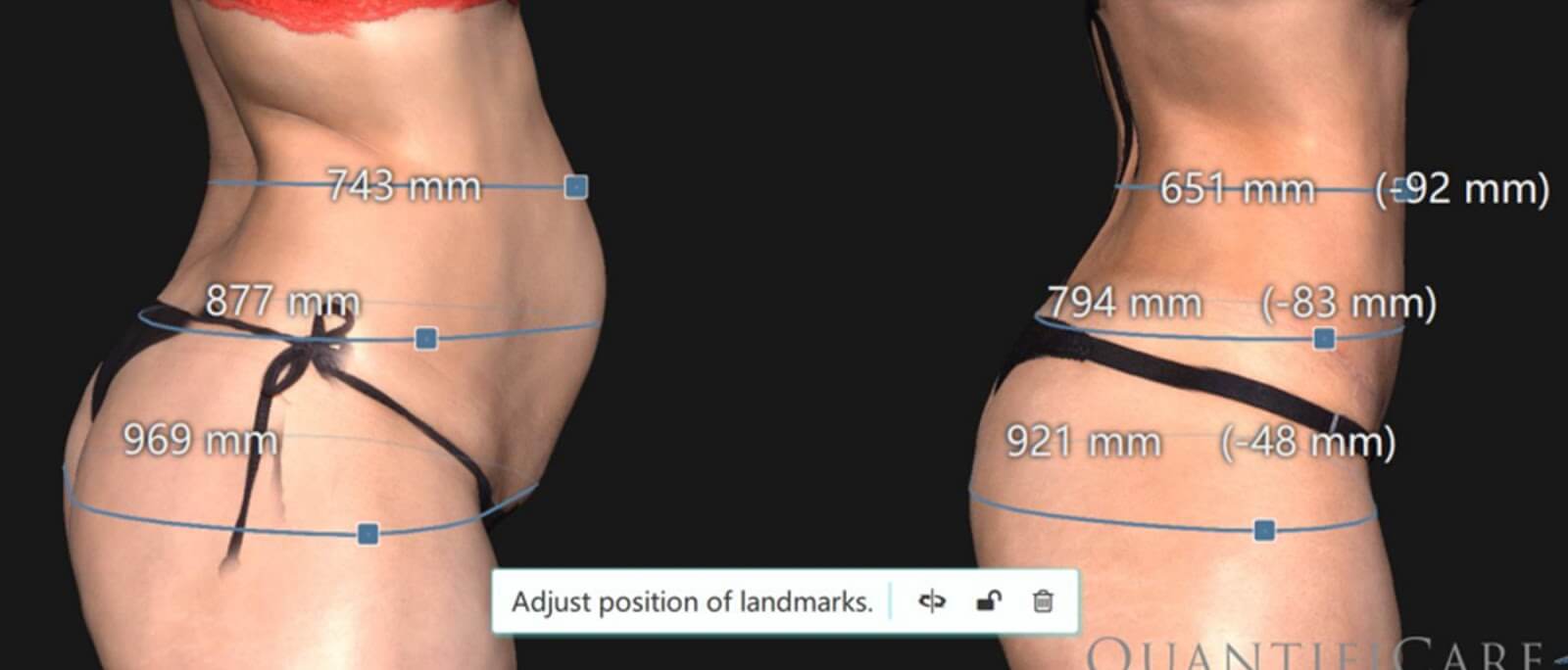 Quantificare 3D影像系統-精準測量體圍