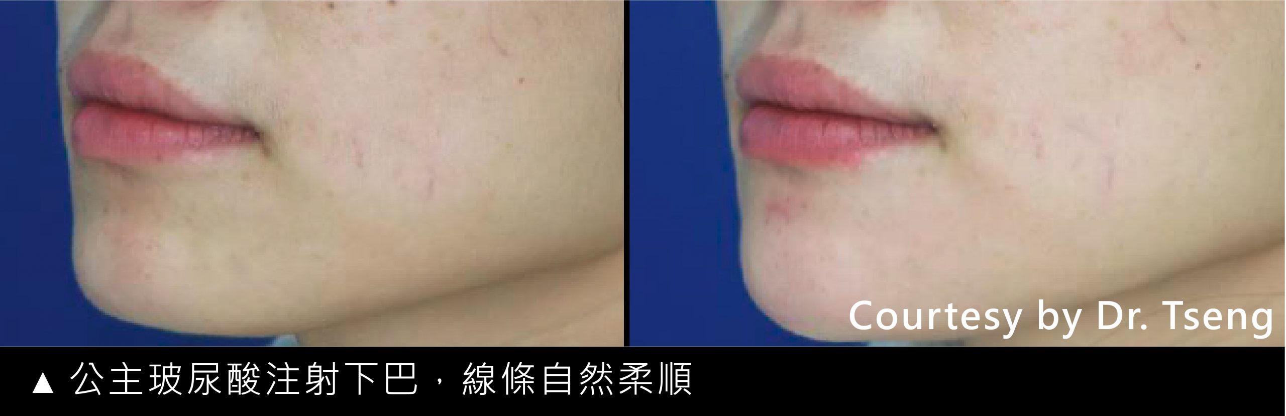 公主玻尿酸下巴
