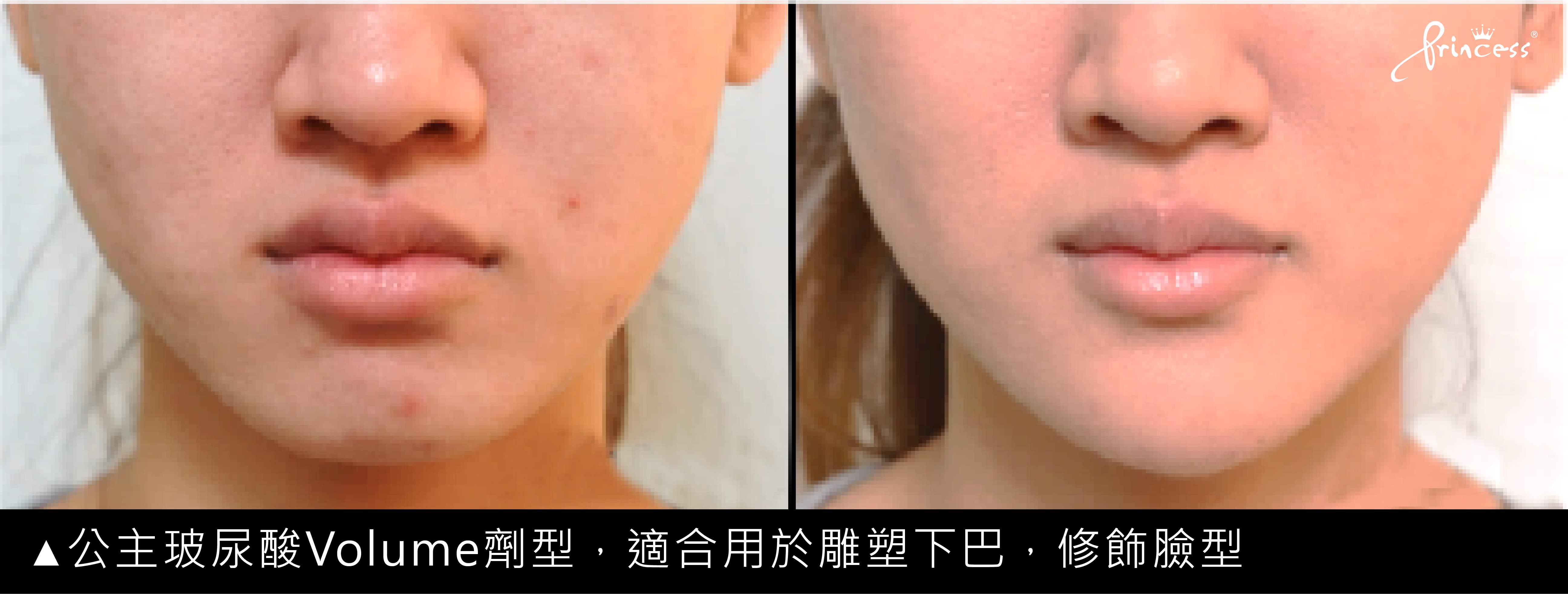 公主玻尿酸下巴