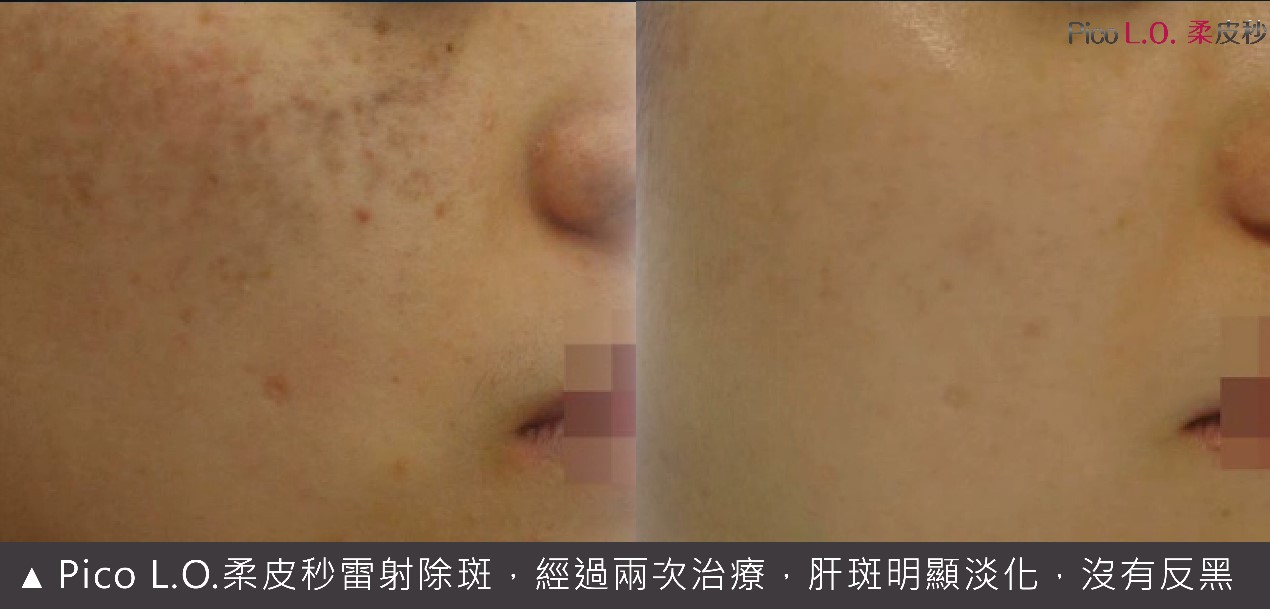 柔皮秒除斑