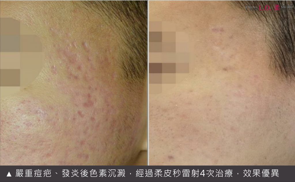 柔皮秒痘疤治療