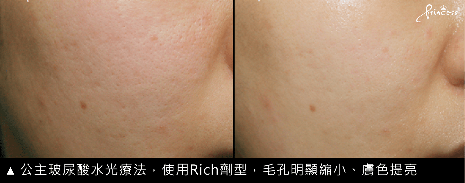 公主玻尿酸水光療法，使用Rich劑型，毛孔明顯縮小、膚色提亮