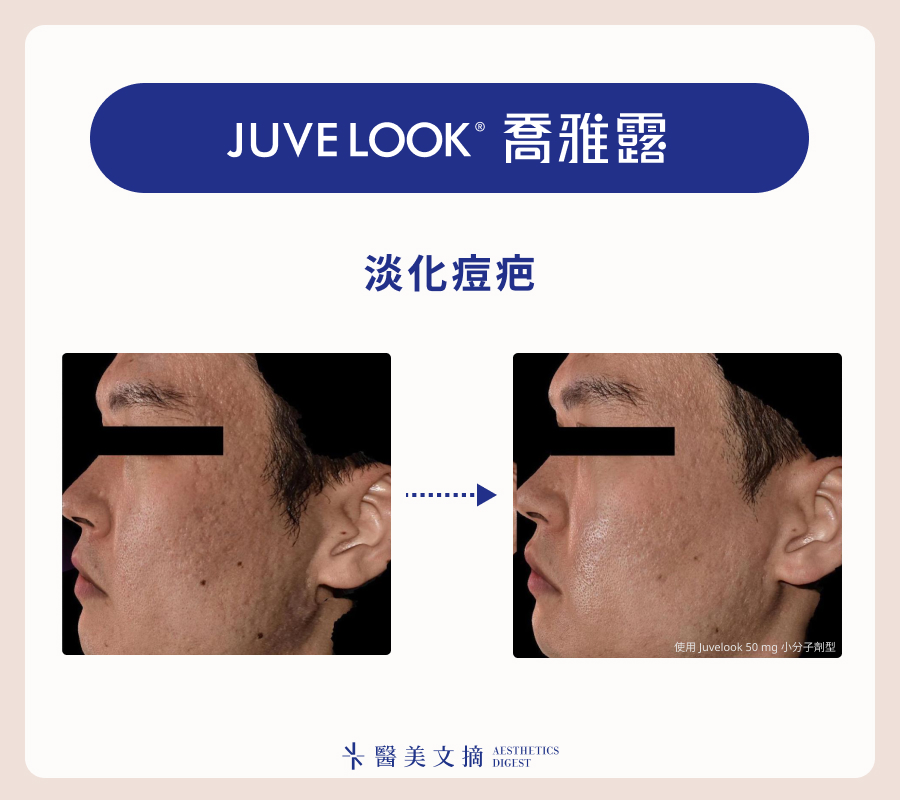 喬雅露淡化痘疤