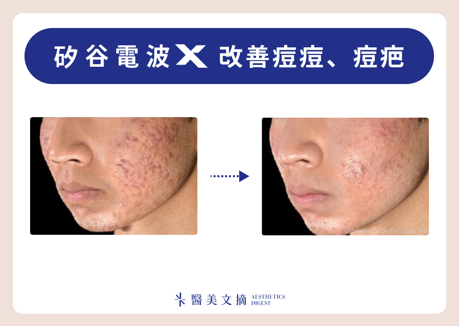 矽谷電波X治療痘疤效果