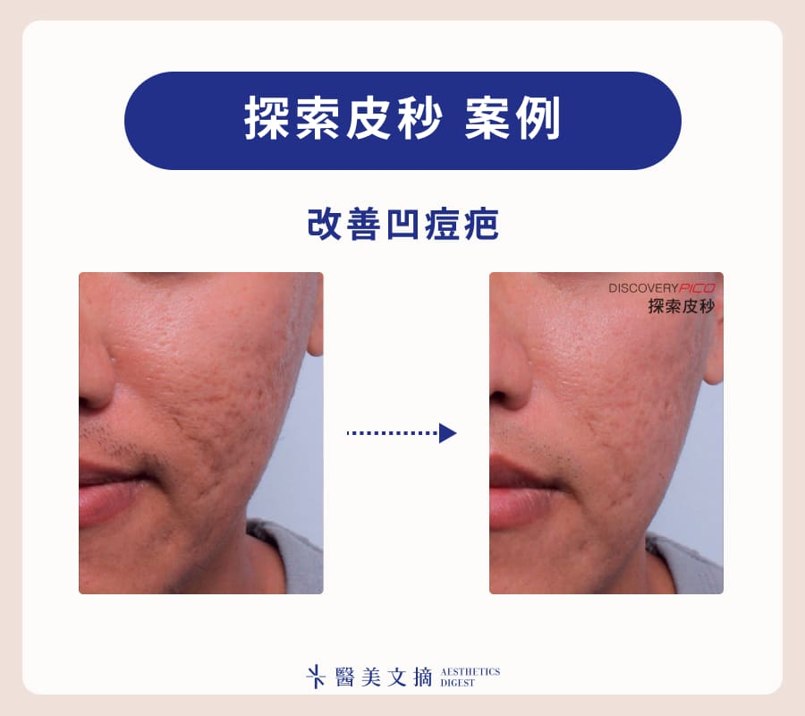 皮秒雷射治療痘疤效果