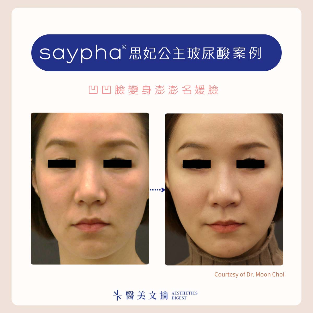 思妃公主玻尿酸案例圖