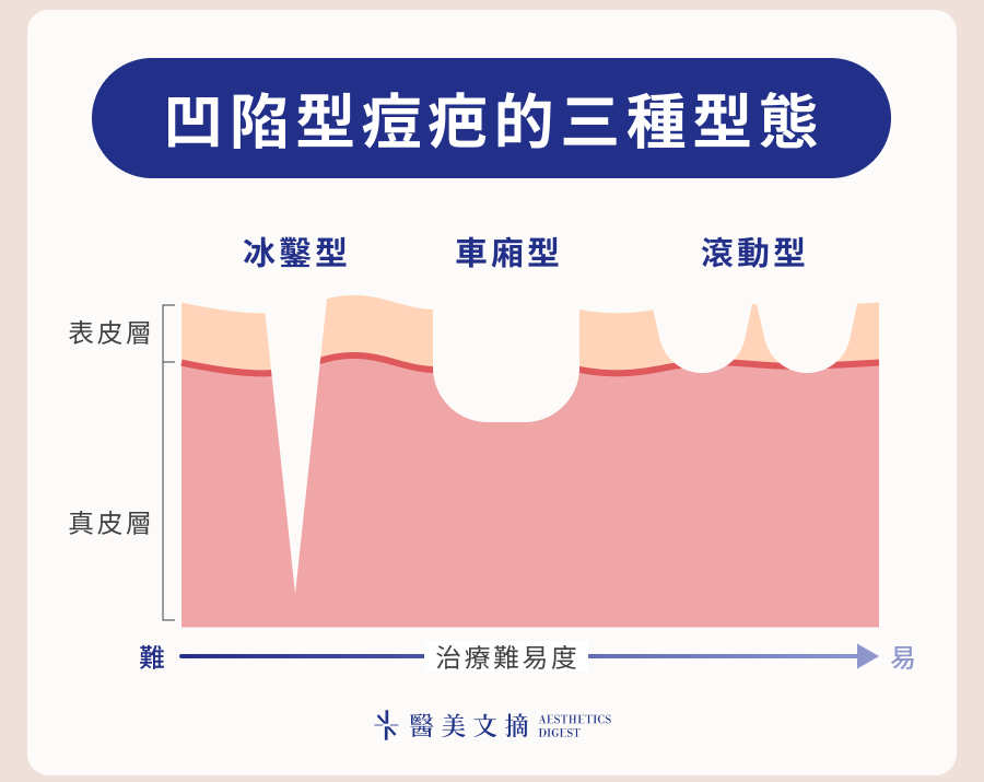 凹陷型痘疤的三種型態