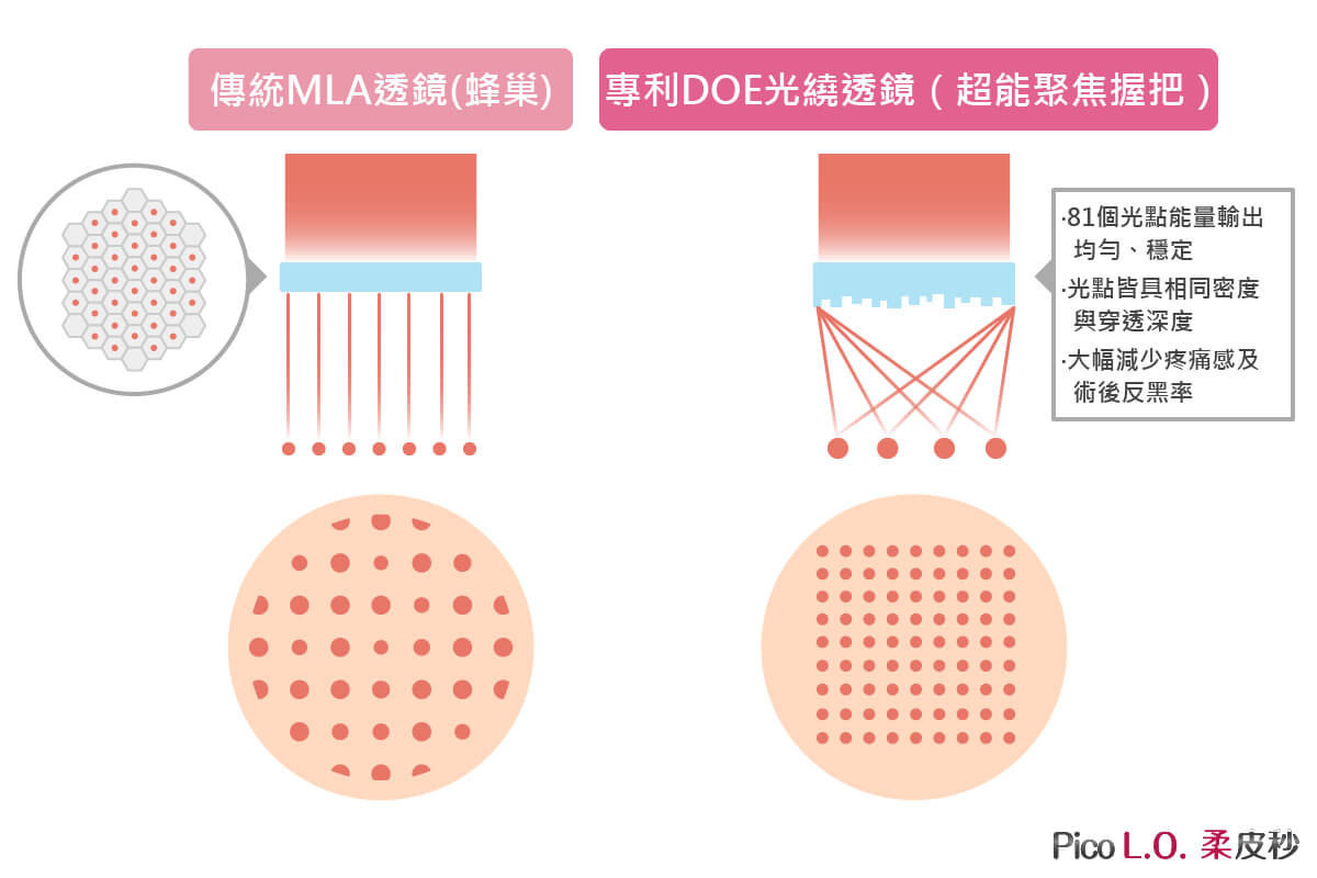 獨家專利的DOE透鏡（超能聚焦透鏡），輸出能量更均勻、穩定