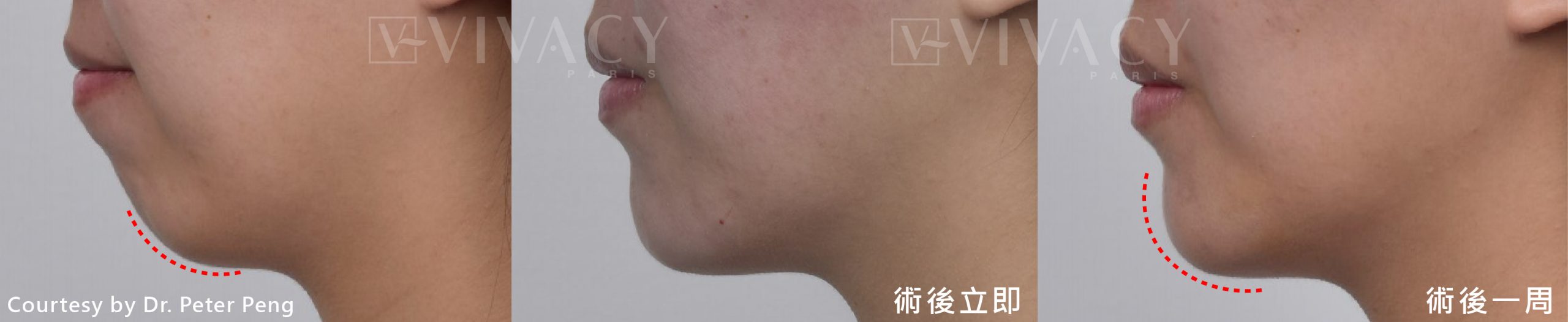 Vivacy小香風玻尿酸修復期