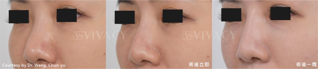 Vivacy小香風玻尿酸修復期