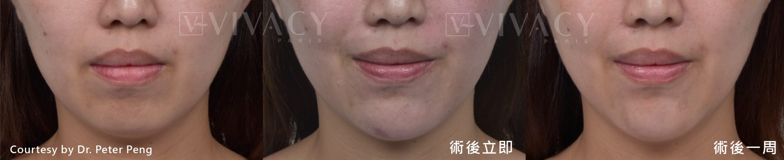 Vivacy小香風玻尿酸修復期