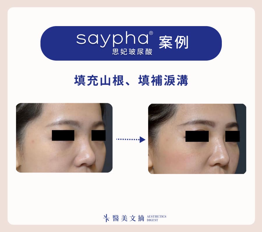 思妃隆鼻案例