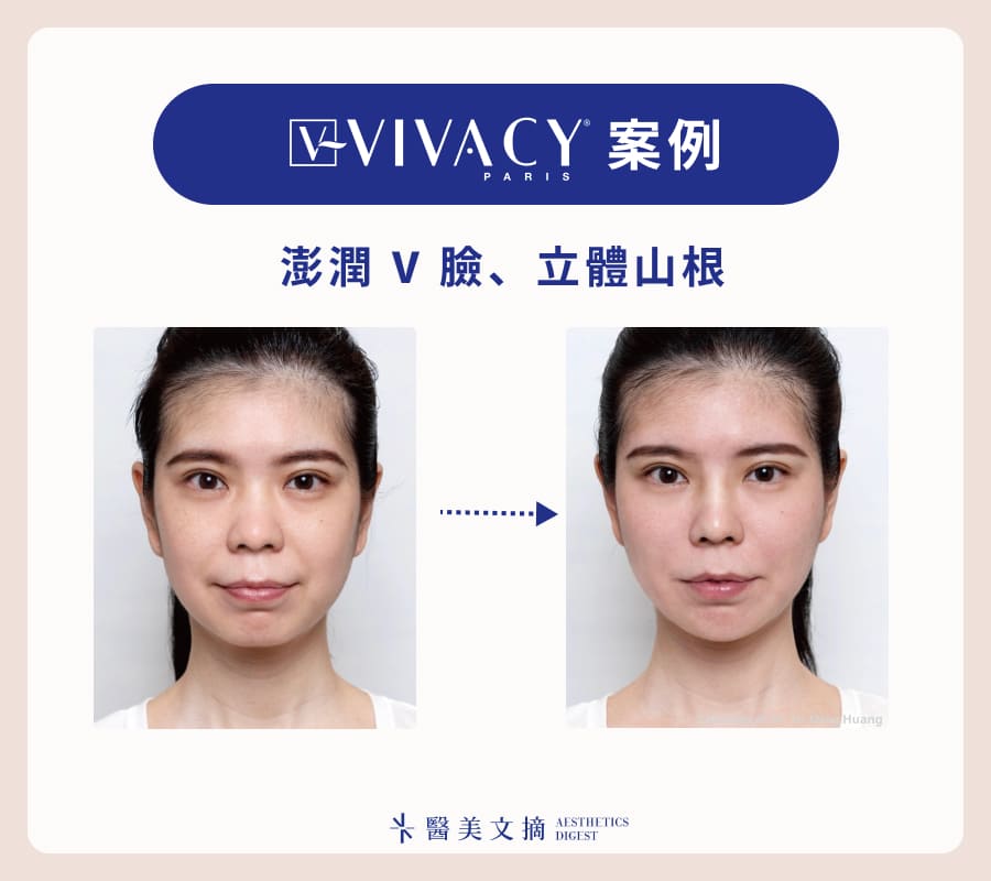 魔V針隆鼻案例